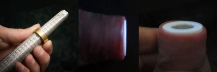 Phimosis treatment help